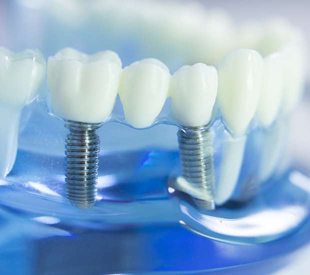 New Rochelle Dental Implants