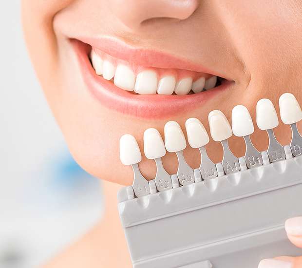 New Rochelle Dental Veneers and Dental Laminates
