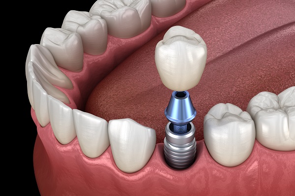 Implant Supported Dentures New Rochelle, NY