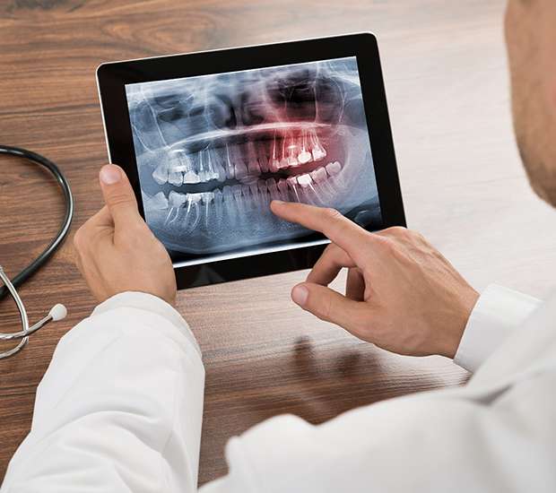 New Rochelle Types of Dental Root Fractures